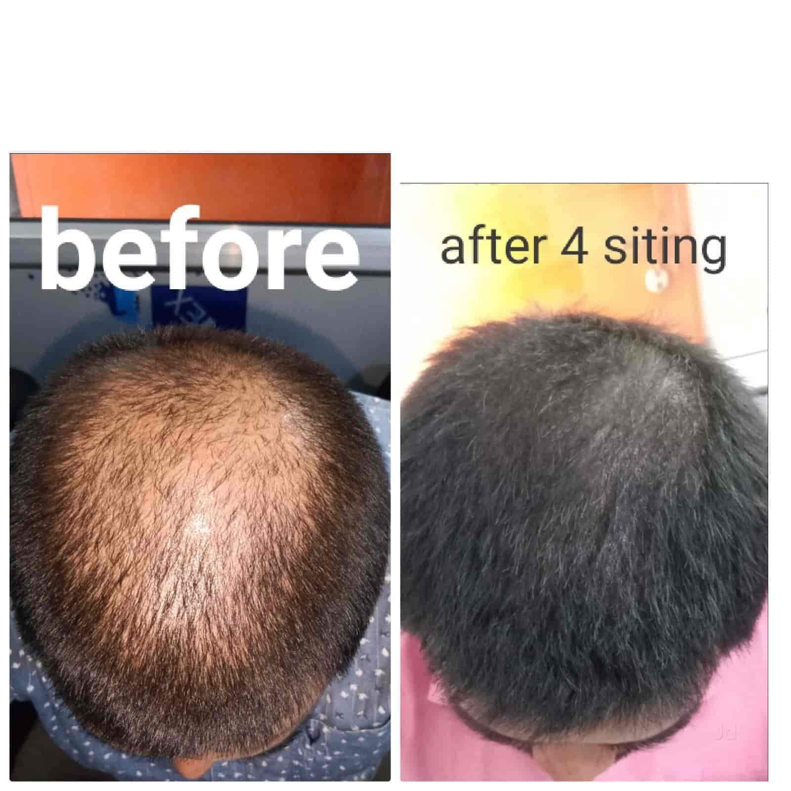 Hijama For Hair Loss